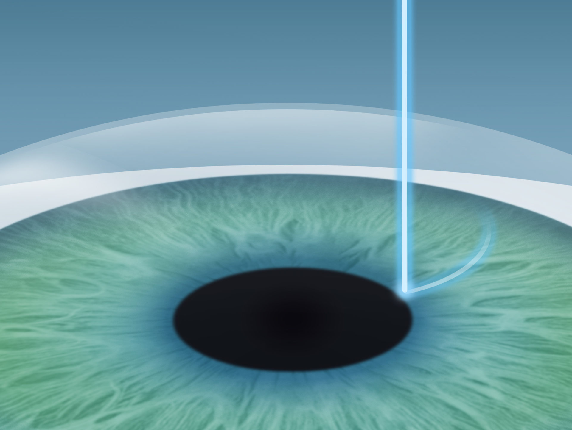 Der Laser formt ein Hornhautscheibchen (Lentikel).