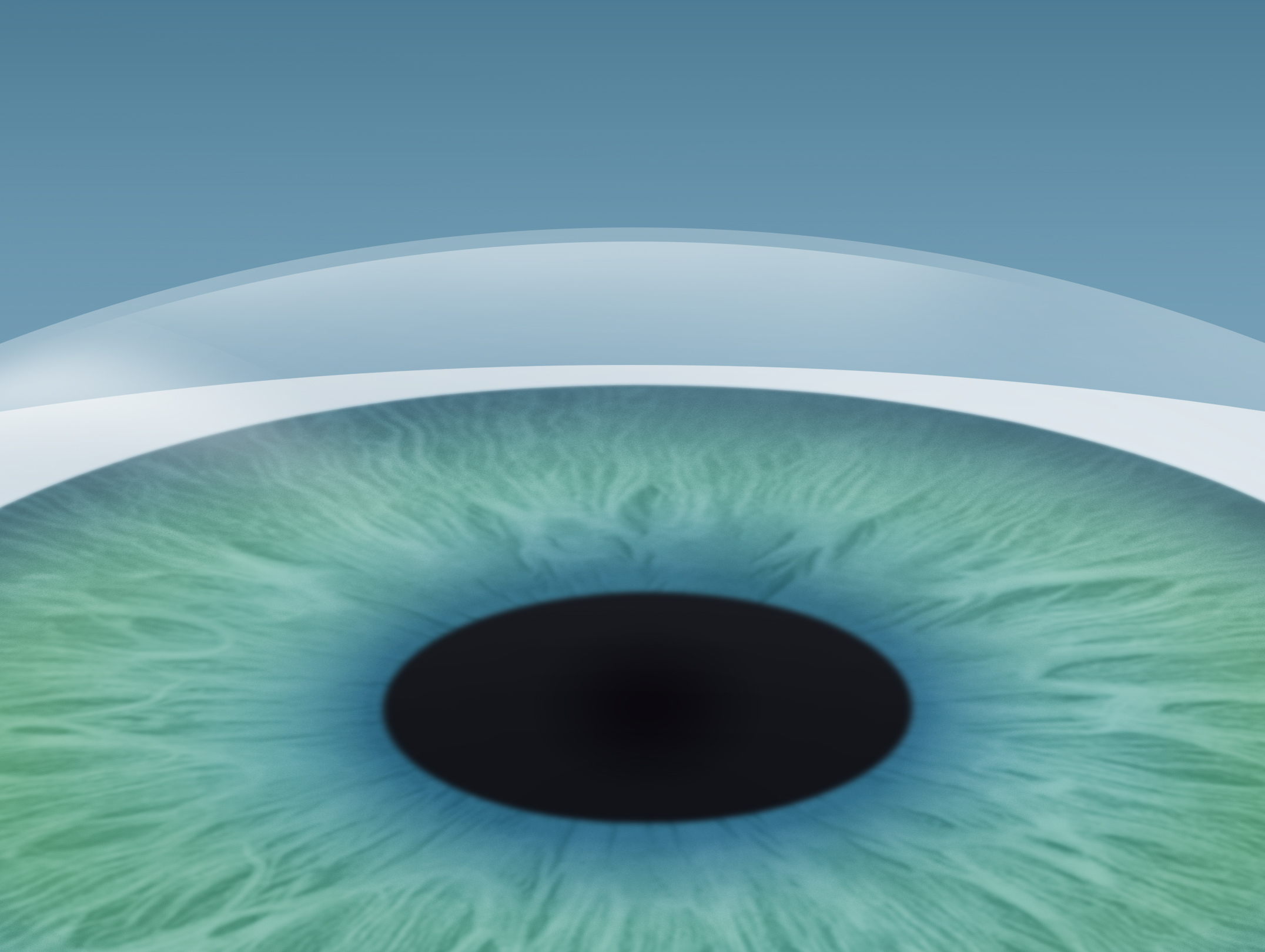 Die Fehlsichtigkeit ist korrigiert, das Auge sieht unverändert aus.