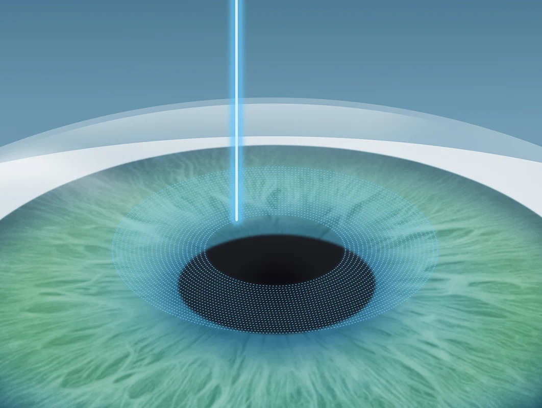Der Femtosekundenlaser formt den sogenannten Flap.
