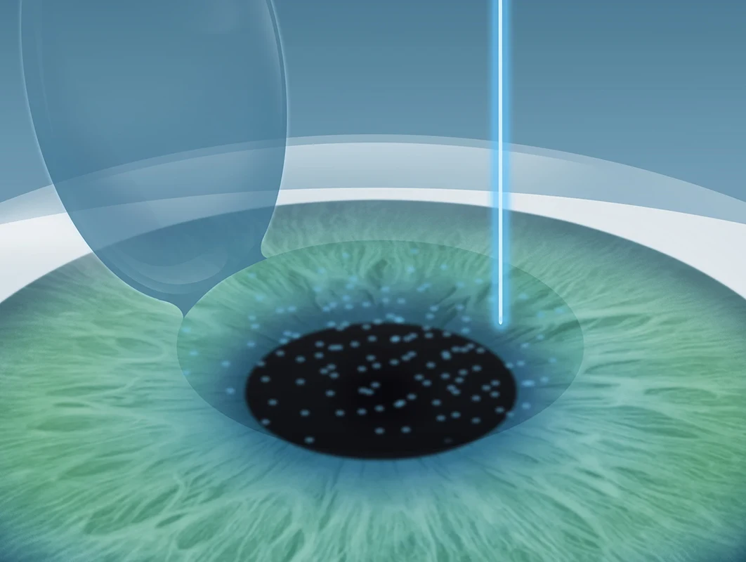 Der Flap wird hochgeklappt und ein Excimer-Laser modelliert das darunterliegende Gewebe.