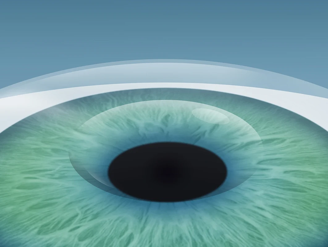 Der Flap wird an die ursprüngliche Position zurückgeklappt und die Femto-LASIK ist abgeschlossen.
