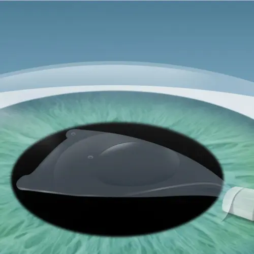 Eine sogenannte ICL-Linse wird in das Auge eingesetzt, um die Fehlsichtigkeit dauerhaft zu korrigiert.